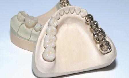 Symbolbild: Zahnarzt Nürnberg Amalgam Alternativen
