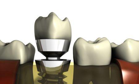 Symbolbild: Zahnarzt Nürnberg Implantologie